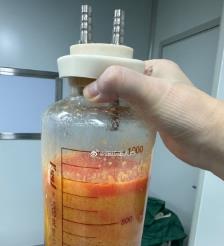 垦利水动力吸脂手术要做多久？